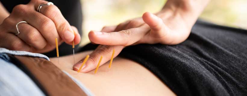 patient receiving Dry Needling in McKinney for auto accident injury recovery