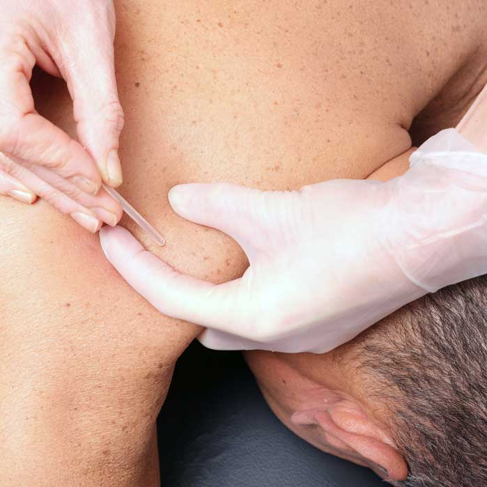 patient getting Dry Needling for auto accident injury in McKinney